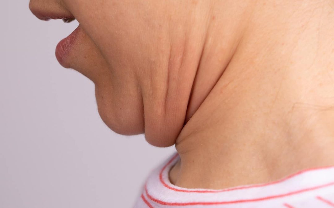 Neck Fat: Causes, Implications And Corrective Tips: HealthifyMe